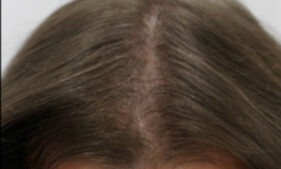 Léčba vypadávání vlasů - foto PO
