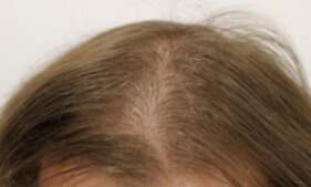 Léčba vypadávání vlasů - foto PŘED